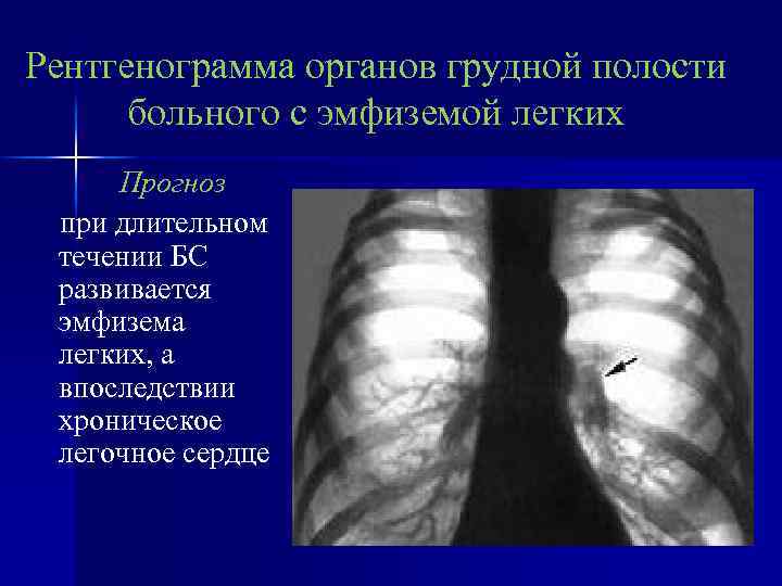 Буллы в легких что это такое. Буллезная эмфизема рентген. Хроническая эмфизема легких рентген. Буллёзная эмфизема лёгких рентген.