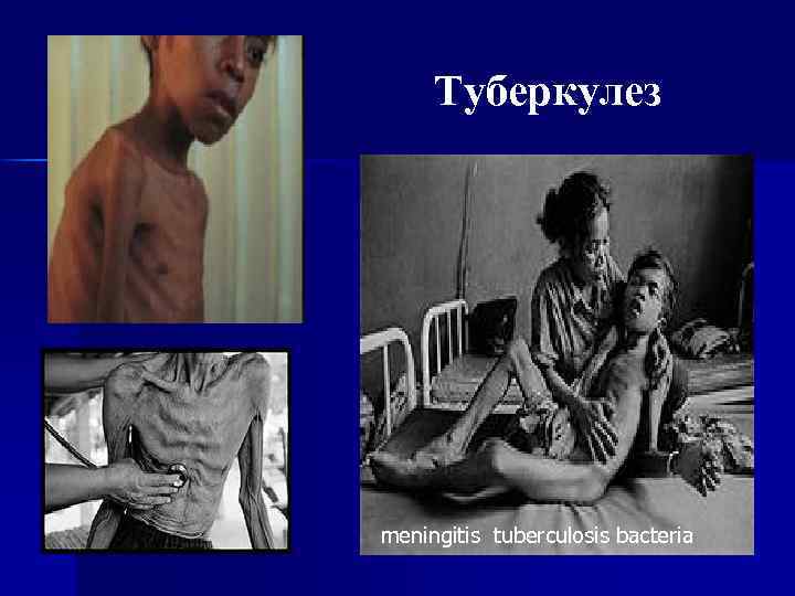 Туберкулез meningitis tuberculosis bacteria 