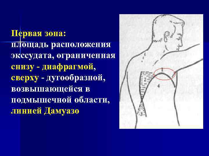 Первая зона: площадь расположения экссудата, ограниченная снизу - диафрагмой, сверху - дугообразной, возвышающейся в
