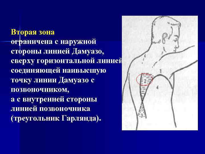 Вторая зона ограничена с наружной стороны линией Дамуазо, сверху горизонтальной линией, соединяющей наивысшую точку