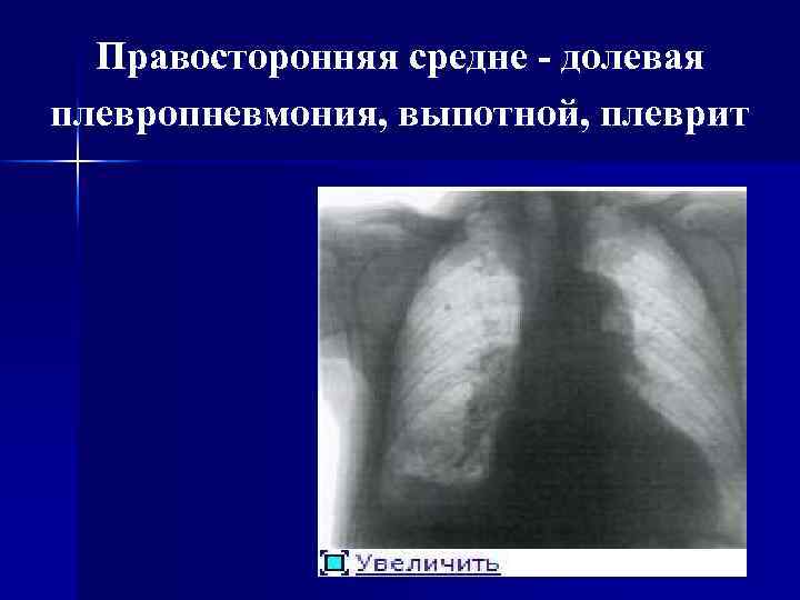 Плевропневмония. Плевропневмония рентген признаки. Правосторонняя среднедолевая пневмония. Правосторонняя среднедолевая плевропневмония что это. Правосторонняя среднедолевая пневмония рентген.