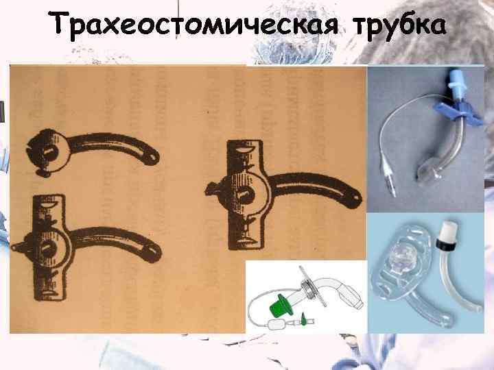 Трахеостомическая трубка 