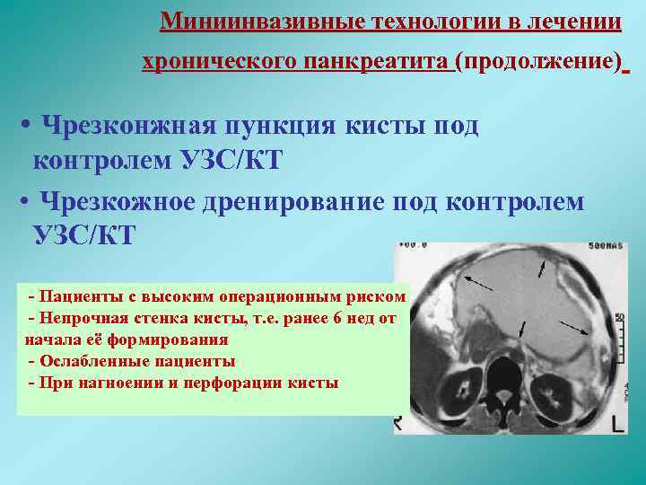 Миниинвазивные технологии в лечении хронического панкреатита (продолжение) • Чрезконжная пункция кисты под контролем УЗС/КТ