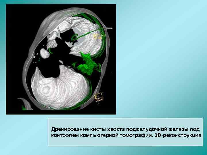 Дренирование кисты хвоста поджелудочной железы под контролем компьютерной томографии. 3 D-реконструкция 