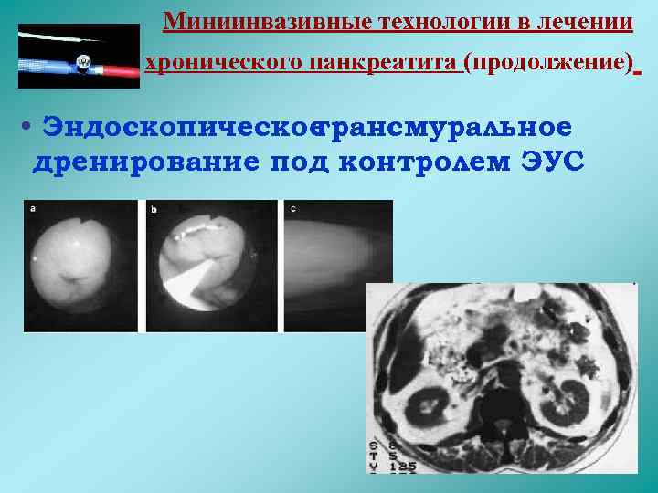 Миниинвазивные технологии в лечении хронического панкреатита (продолжение) • Эндоскопическое трансмуральное дренирование под контролем ЭУС