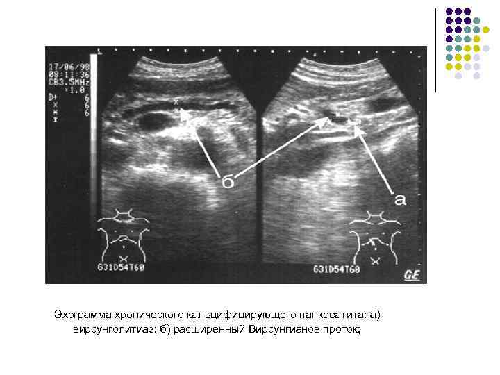 Эхограмма хронического кальцифицирующего панкреатита: а) вирсунголитиаз; б) расширенный Вирсунгианов проток; 