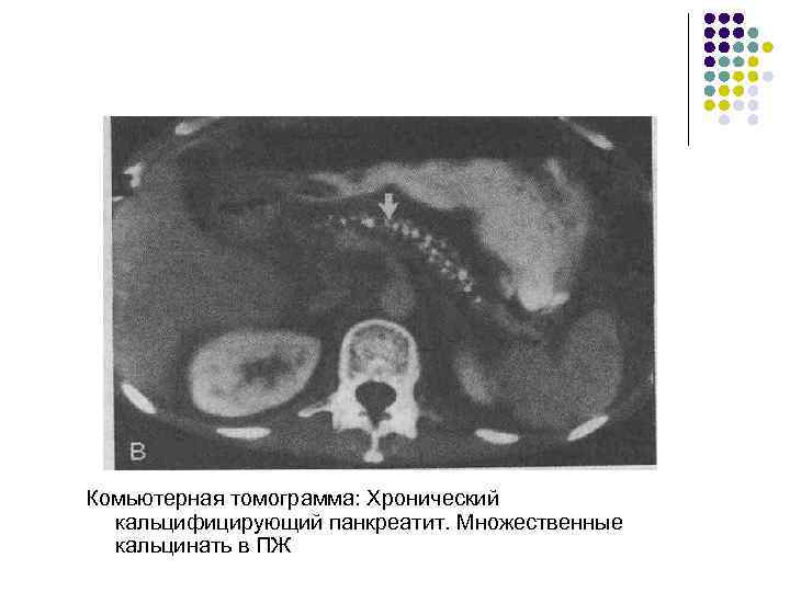 Клиническая картина хронического панкреатита