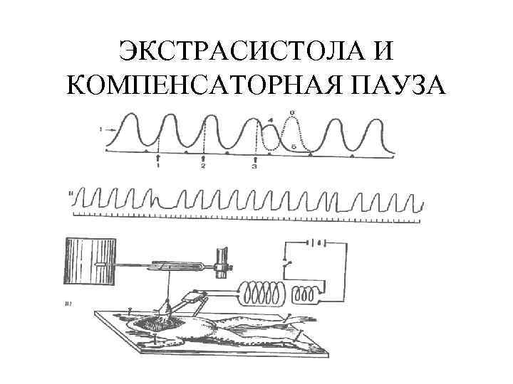 ЭКСТРАСИСТОЛА И КОМПЕНСАТОРНАЯ ПАУЗА 