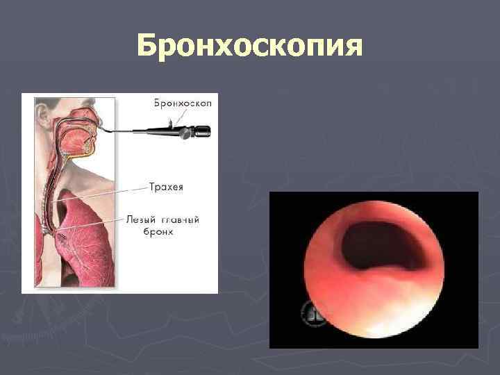 Бронхоскопия это. Бронхоскопия амбулаторно. Бронхоскопия с прицельной биопсией.