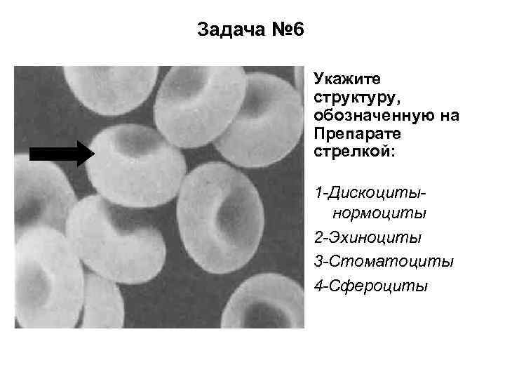 Задача № 6 Укажите структуру, обозначенную на Препарате стрелкой: 1 -Дискоцитынормоциты 2 -Эхиноциты 3