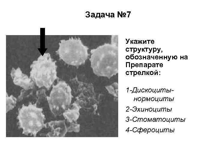 Задача № 7 Укажите структуру, обозначенную на Препарате стрелкой: 1 -Дискоцитынормоциты 2 -Эхиноциты 3