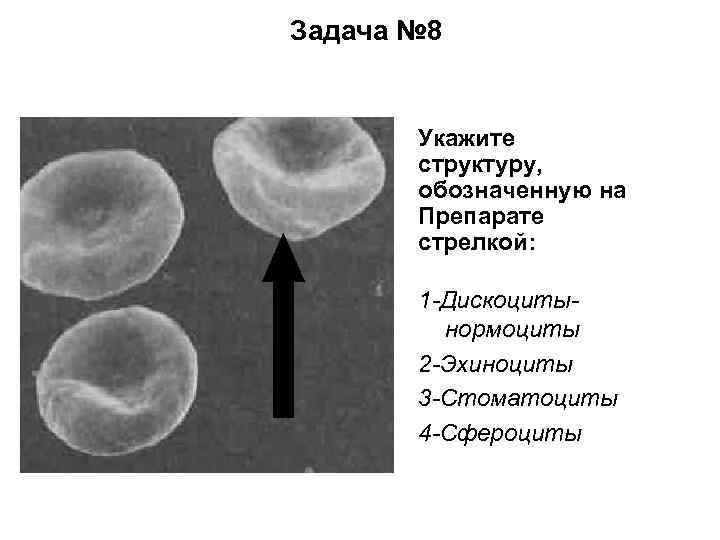 Задача № 8 Укажите структуру, обозначенную на Препарате стрелкой: 1 -Дискоцитынормоциты 2 -Эхиноциты 3