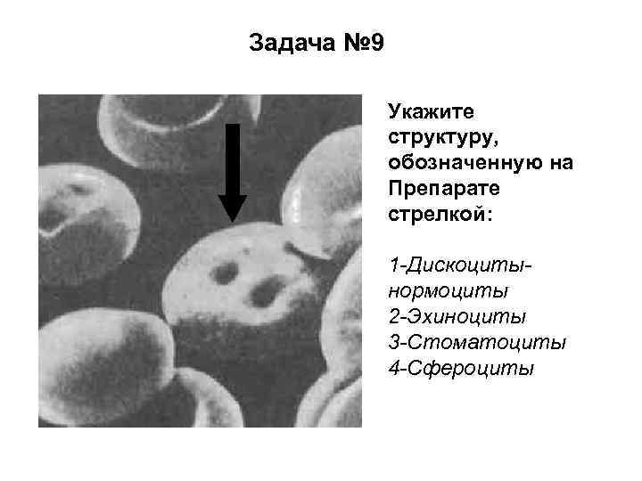 Задача № 9 Укажите структуру, обозначенную на Препарате стрелкой: 1 -Дискоцитынормоциты 2 -Эхиноциты 3