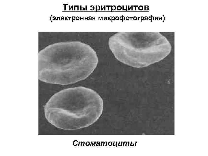 Типы эритроцитов (электронная микрофотография) Стоматоциты 