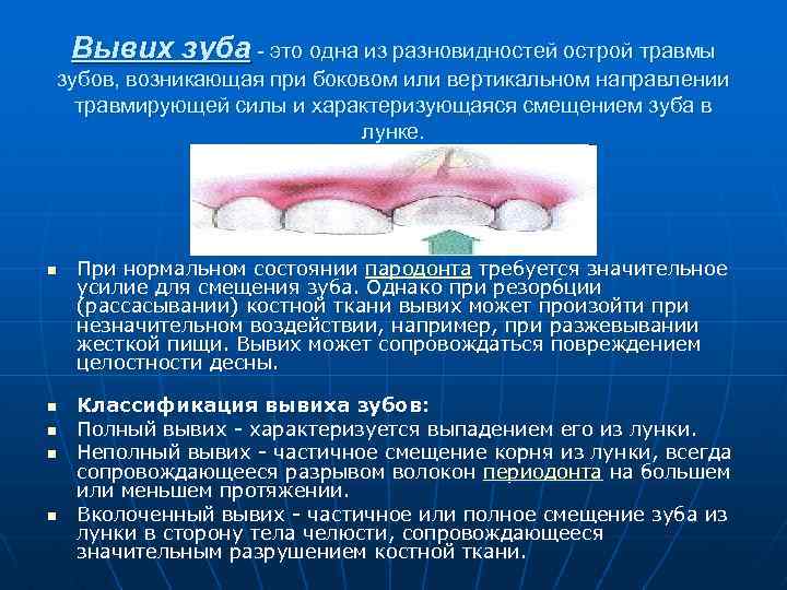  Вывих зуба - это одна из разновидностей острой травмы зубов, возникающая при боковом
