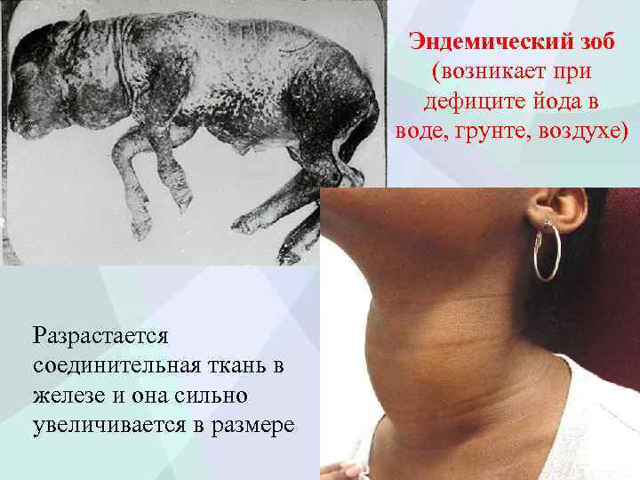 Эндемический зоб (возникает при дефиците йода в воде, грунте, воздухе) Разрастается соединительная ткань в