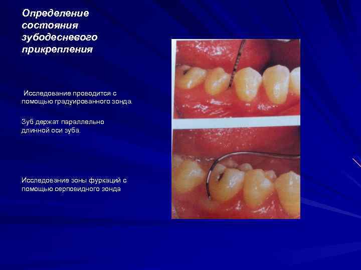 Определение состояния зубодесневого прикрепления Исследование проводится с помощью градуированного зонда. Зуб держат параллельно длинной