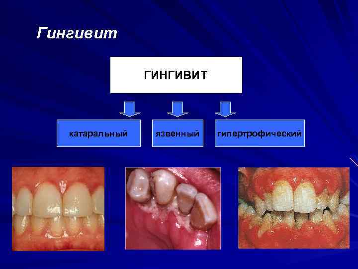 Гингивит ГИНГИВИТ катаральный язвенный гипертрофический 