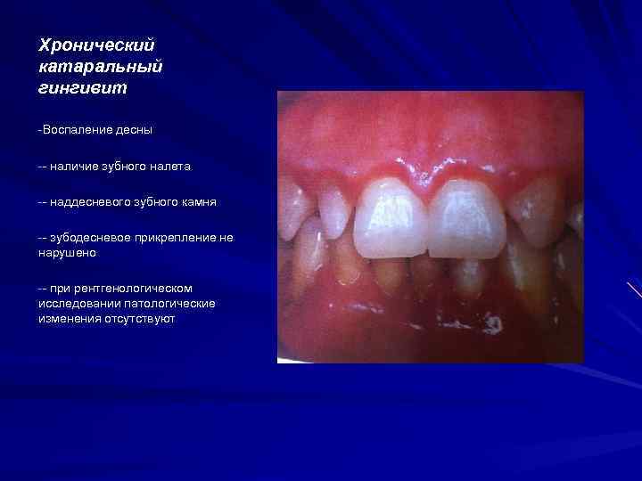 Хронический катаральный гингивит -Воспаление десны -- наличие зубного налета -- наддесневого зубного камня --