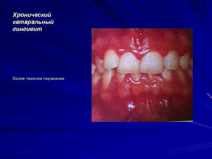 Хронический катаральный гингивит Более тяжелое поражение 