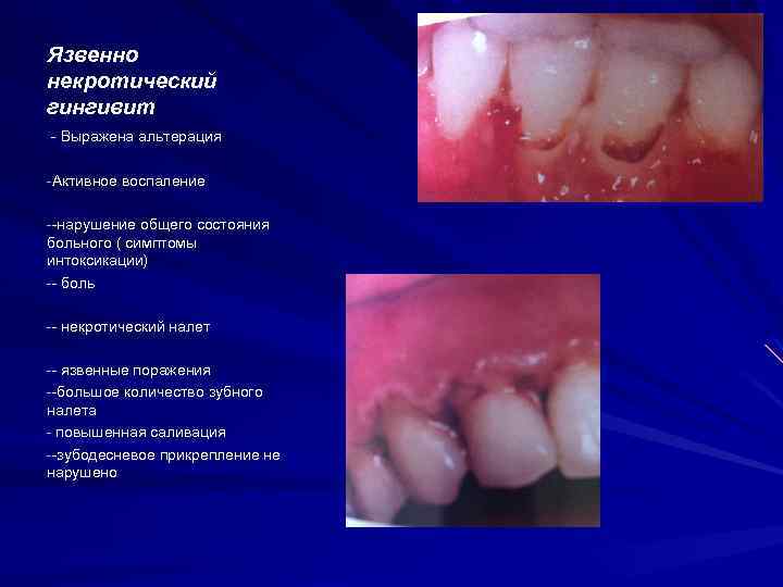 Язвенно некротический гингивит - Выражена альтерация -Активное воспаление --нарушение общего состояния больного ( симптомы
