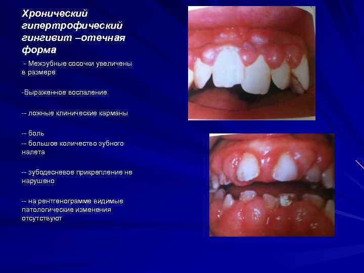 Хронический гипертрофический гингивит –отечная форма - Межзубные сосочки увеличены в размере -Выраженное воспаление --