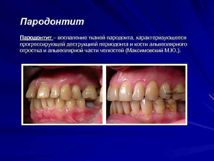 Пародонтит – воспаление тканей пародонта, характеризующееся прогрессирующей деструкцией периодонта и кости альвеолярного отростка и