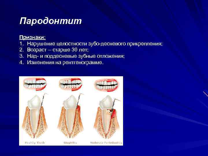 Пародонтит Признаки: 1. Нарушение целостности зубо-десневого прикрепления; 2. Возраст – старше 30 лет; 3.