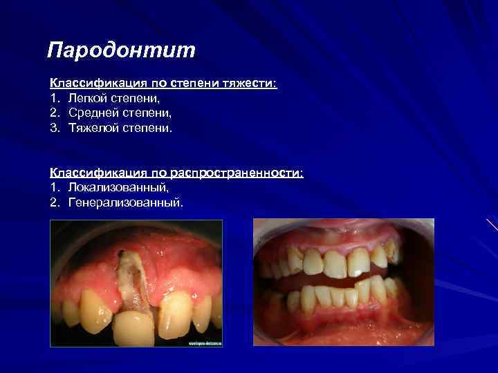 Пародонтит Классификация по степени тяжести: 1. Легкой степени, 2. Средней степени, 3. Тяжелой степени.