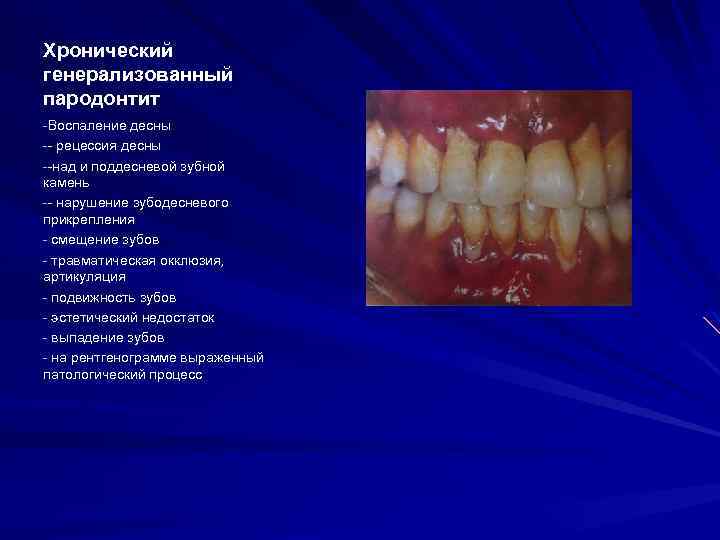 Хронический генерализованный пародонтит -Воспаление десны -- рецессия десны --над и поддесневой зубной камень --