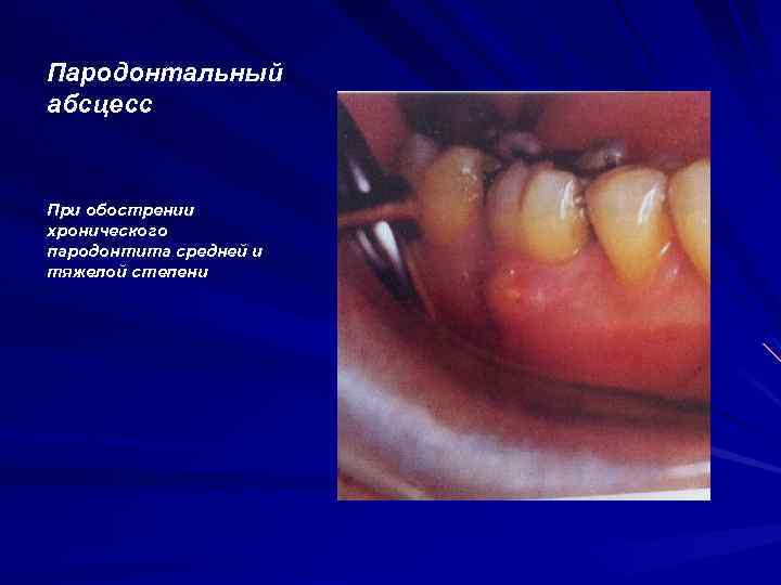 Пародонтальный абсцесс При обострении хронического пародонтита средней и тяжелой степени 