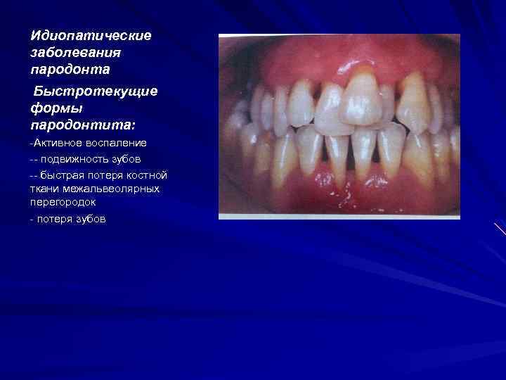 Идиопатические заболевания пародонта Быстротекущие формы пародонтита: -Активное воспаление -- подвижность зубов -- быстрая потеря