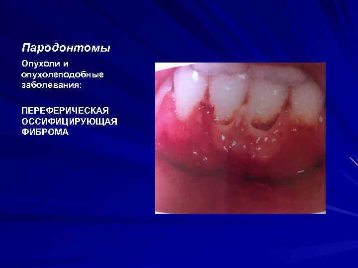 Пародонтомы Опухоли и опухолеподобные заболевания: ПЕРЕФЕРИЧЕСКАЯ ОССИФИЦИРУЮЩАЯ ФИБРОМА 