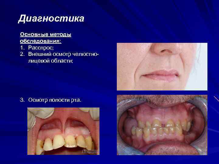 Диагностика Основные методы обследования: 1. Расспрос; 2. Внешний осмотр челюстнолицевой области; 3. Осмотр полости