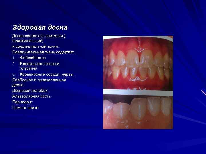 Здоровая десна Десна состоит из эпителия ( ороговевающий) и соединительной ткани. Соединительная ткань содержит: