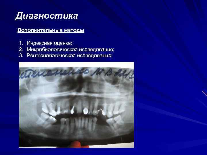 Диагностика Дополнительные методы 1. Индексная оценка; 2. Микробиологическое исследование; 3. Рентгенологическое исследование; 