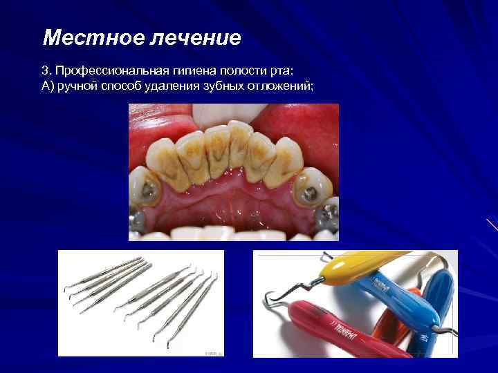 Местное лечение 3. Профессиональная гигиена полости рта: А) ручной способ удаления зубных отложений; 