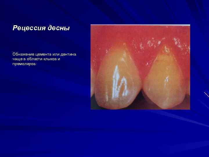 Рецессия десны Обнажение цемента или дентина чаще в области клыков и премоляров. 