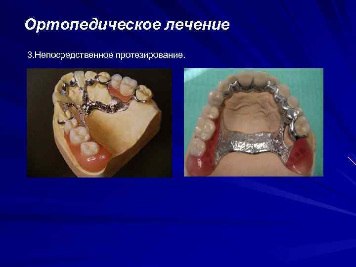 Ортопедическое лечение 3. Непосредственное протезирование. 