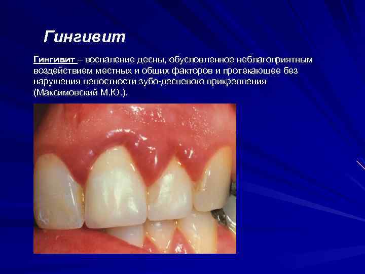 Гингивит – воспаление десны, обусловленное неблагоприятным воздействием местных и общих факторов и протекающее без