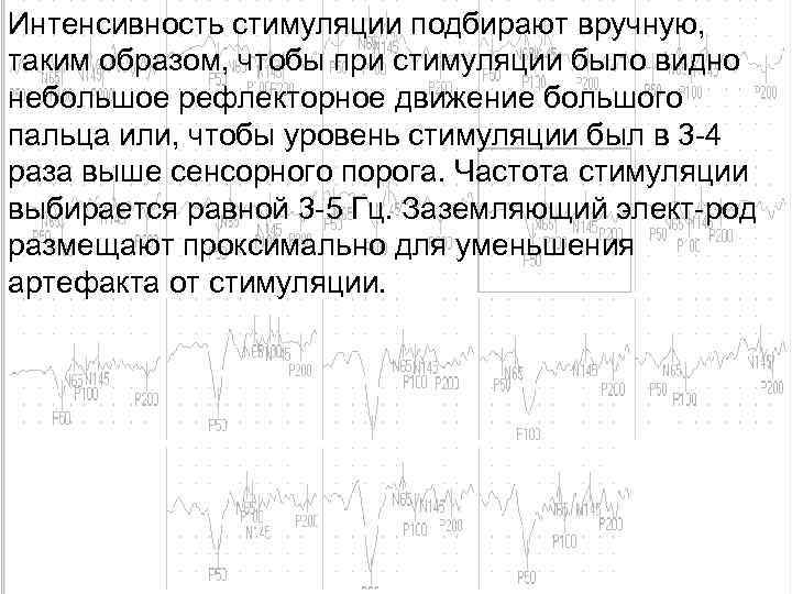 Интенсивность стимуляции подбирают вручную, таким образом, чтобы при стимуляции было видно небольшое рефлекторное движение