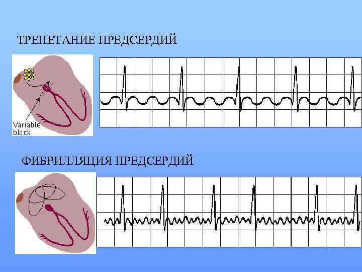 ТРЕПЕТАНИЕ ПРЕДСЕРДИЙ ФИБРИЛЛЯЦИЯ ПРЕДСЕРДИЙ 