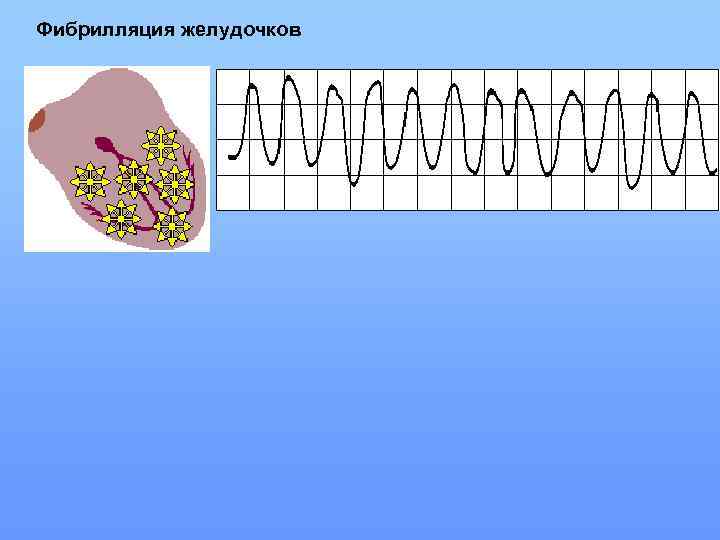 Фибрилляция желудочков 