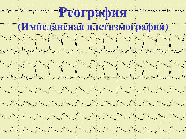 Реография (Импедансная плетизмография) 