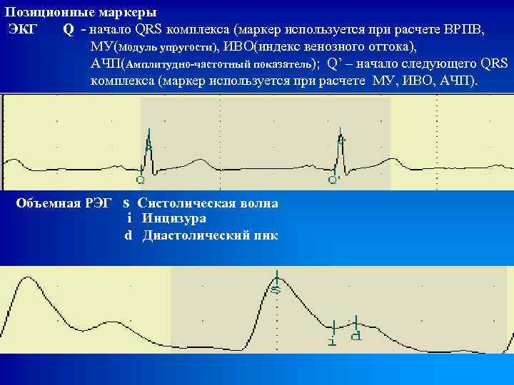 Позиционные маркеры ЭКГ Q - начало QRS комплекса (маркер используется при расчете ВРПВ, МУ(модуль