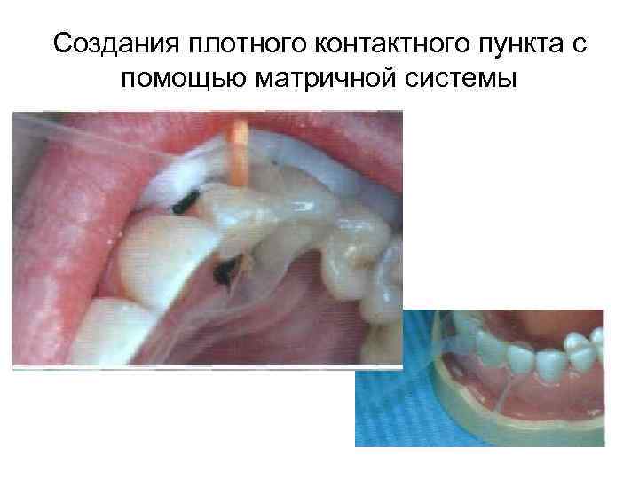 Создания плотного контактного пункта с помощью матричной системы 