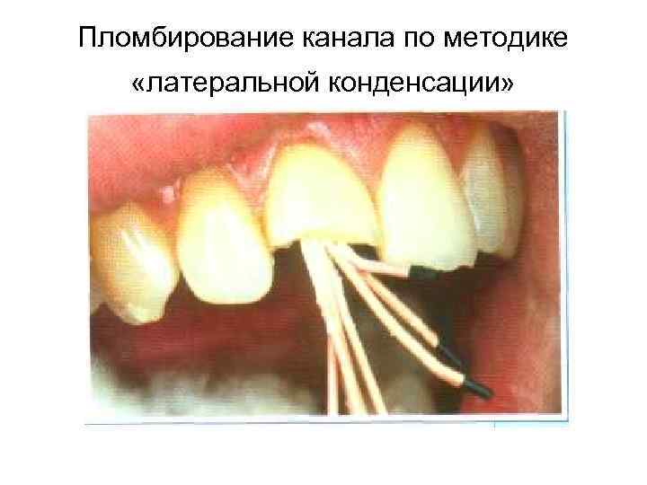 Пломбирование канала по методике «латеральной конденсации» 