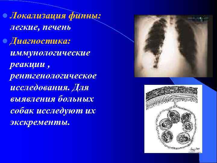 l Локализация финны: легкие, печень l Диагностика: иммунологические реакции , рентгенологическое исследования. Для выявления