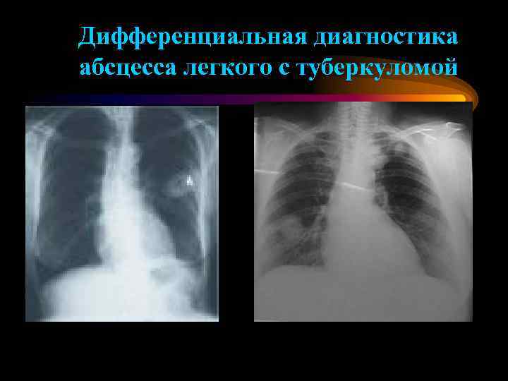 Дифференциальная диагностика абсцесса легкого с туберкуломой 