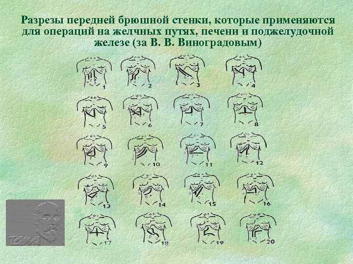 Разрезы передней брюшной стенки, которые применяются для операций на желчных путях, печени и поджелудочной